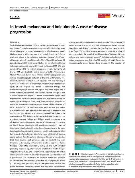in transit disease melanoma
